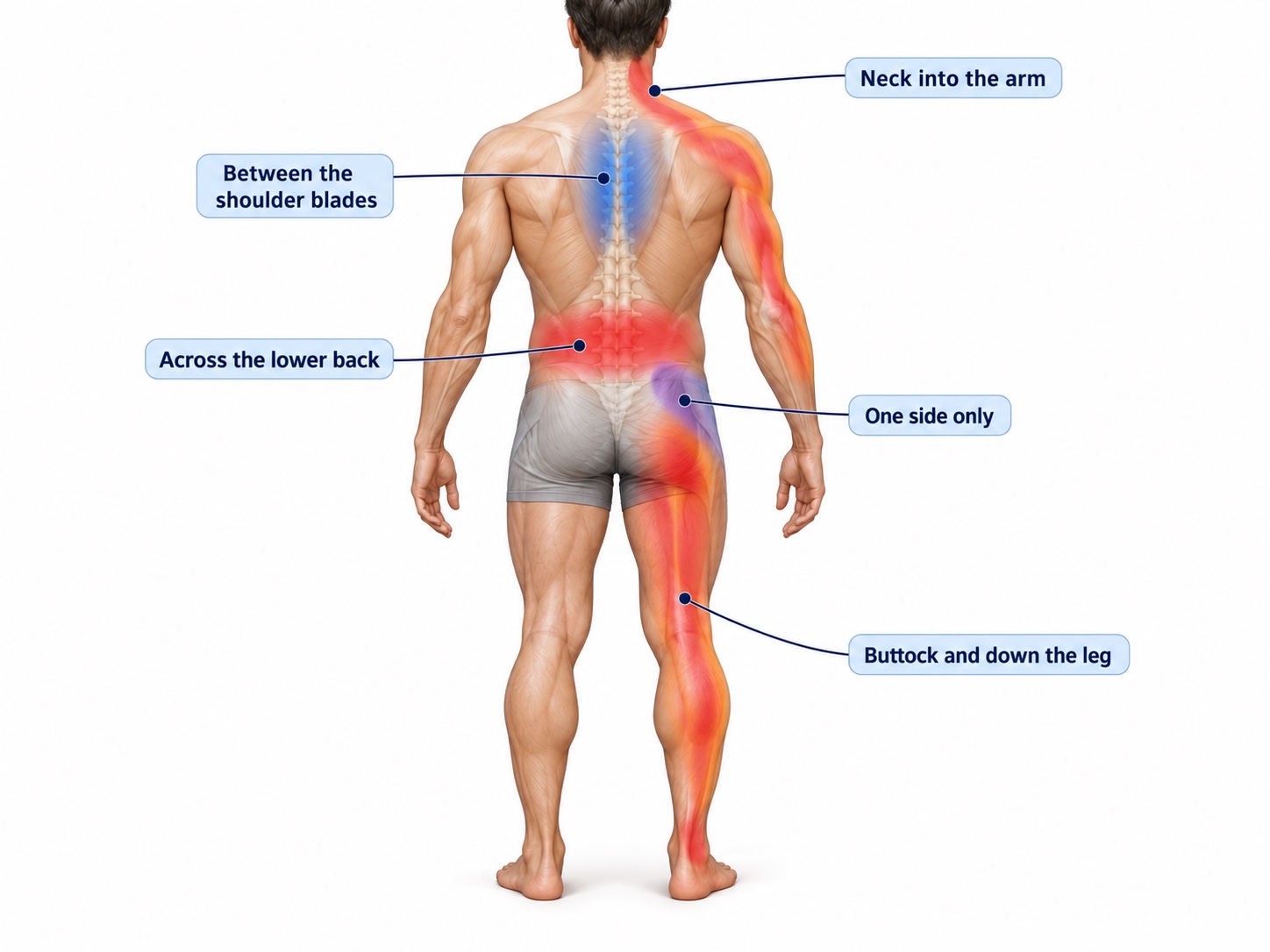Diagram of the back showing the five common pain locations: across the lower back, low down on one side, buttock and down the leg, between the shoulder blades, and the neck radiating into the arm